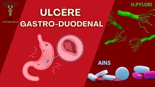 Ulcère GastroDuodenal [upl. by Nainatrad]