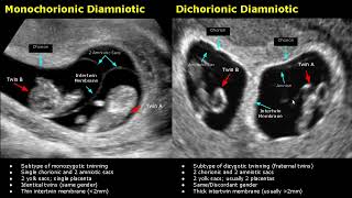 Fetal Twins Ultrasound Normal Vs Abnormal  MonochorionicDichorionicDiamnioticMonoamniotic USG [upl. by Anirbaz609]