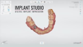 3Shape Trios Implant Impression [upl. by Ellehsad]