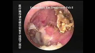 Two cases of cholesteatoma with significant differences [upl. by Achorn]