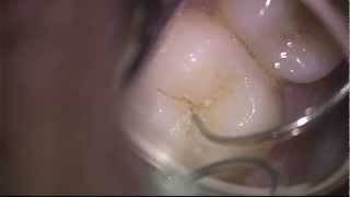 Problem with Sealants [upl. by Rhett]