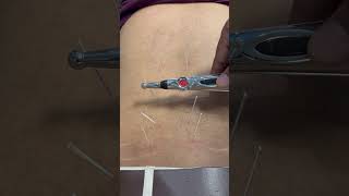 Dryneedling therapy for back pain pushpa2 dryneedling backpain physicaltherapy [upl. by Gladys]