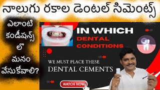 Which Type of Teeth Cement Filling Needed  ఎటువంటి పంటి సిమెంట్ ఎక్కడ వేసుకోవాలి అనేది చూద్దాం [upl. by Ninnette]