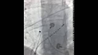 AF ablation with Rhythmia system [upl. by Adonis]