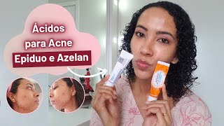 MINHA EXPERIÊNCIA COM ACIDO AZELAN E EPIDUO JUNTOS [upl. by Miarhpe]