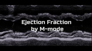 Ejection Fraction by MMode [upl. by Kosaka]