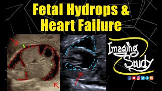 Fetal Hydrops amp Heart Failure  Ultrasound  Anomaly  Case 293 [upl. by Herzel]