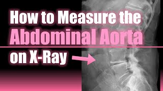 How to Measure the Abdominal Aorta on X Ray 📏🫀🩻howto medical doctor [upl. by Sup]