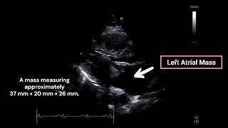 Left Atrial Mass [upl. by Dobson532]