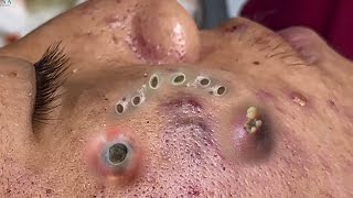 Big Cystic Acne Blackheads Extraction Blackheads amp Milia Whiteheads Removal Pimple Popping 090 [upl. by Cassidy]