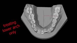 VTO LOWER CROWDING NO OVERJET treating with clear aligners [upl. by Hermon]