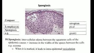 Histopathology 3 👉 acantholysis amp spongiosis amp ballooning [upl. by Forrest]