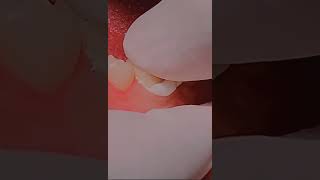 Crown cementation to protect root canal treated teeth dentist teeth tooth dentista dentistteeth [upl. by Filemon]