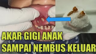 Akar Gigi Anak Sampai Nembus Gusi Ulcus Decubitus [upl. by Oidale772]