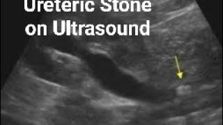 Ureteric stone on Ultrasound [upl. by Tnecillim]