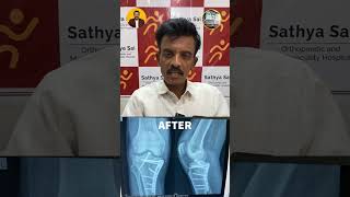 Mr Kanthrajs Recovery Journey from Posteromedial Condyle Fracture [upl. by Aivatan82]