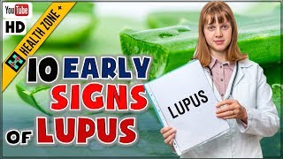 10 Early Signs and Symptoms of Lupus You Shouldn’t Ignore [upl. by Aihsena]