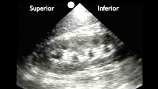 How To Renal Ultrasound  Hydronephrosis Case Study Video [upl. by Arvy]