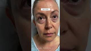 Puffy Lower Eye Bags amp Hooded Upper Eyelids Treatment with Dr Kami Parsa [upl. by Lizzie778]