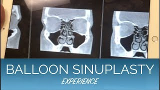 Balloon Sinuplasty Septoplasty and Turbinate Reduction  EXPERIENCE and COST breakdown [upl. by Malinda]