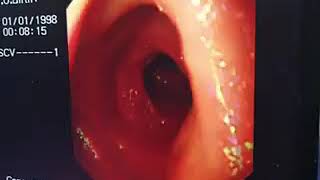 Demonstration of the third and fourth parts of the duodenum using the upper digestive endoscopy [upl. by Nauh425]