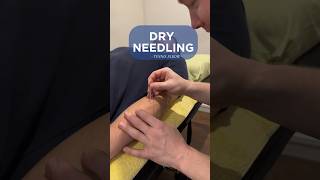 Dry Needling  Tennis Elbow  Treatment [upl. by Joete330]