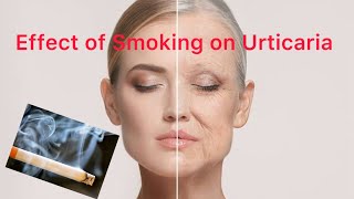 Effect of smoking on urticaria [upl. by Nohpets487]