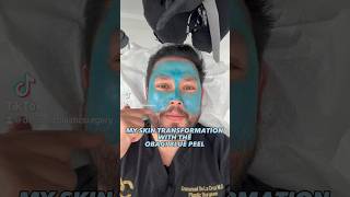 My Skin Transformation with the Obagi Blue Peel [upl. by Naivatco403]