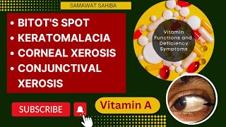 Vitamin A Deficiency  Bitots Spot  Keratomalacia  Corneal Xerosis Conjunctival Xerosis Details [upl. by Erin]