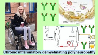 chronic inflammatory demyelinating polyneuropathy [upl. by Supen]