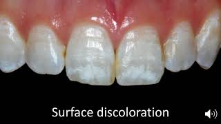 Case Selection for Enamel Microabrasion [upl. by Hodge628]