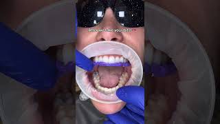 How we make bottom temporary smile before cementing permanent veneers teethclean 🦷beadrepair [upl. by Marras]