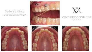 Distalamiento Secuencial Invisalign con Minitornillo Sequential Invisalign Distalization Miniscrew [upl. by Berget]