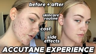 accutane experience  before amp after side effects cost skincare routine [upl. by Ecyla]