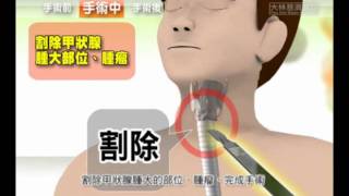 【知情同意】認識甲狀腺切除術國語 [upl. by Adrial]