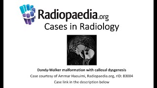 DandyWalker malformation with callosal dysgenesis Radiopaediaorg Cases in Radiology [upl. by Marciano]