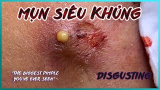 Big Cystic Acne Blackheads Extraction Blackheads amp Milia Whiteheads Removal Pimple Popping [upl. by Ahseenak]