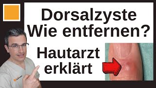 Mukoide Dorsalzyste OP oder andere Therapie Dr Kasten Hautmedizin in Mainz [upl. by Jaylene243]