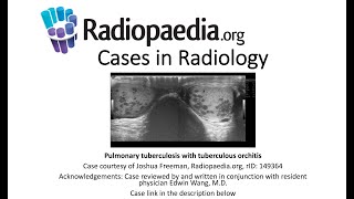 Pulmonary tuberculosis with tuberculous orchitis Radiopaediaorg Cases in Radiology [upl. by Gentille]