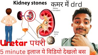 Kidney stonesUreter stone 🪨Cause Symptoms Treatment only in 5 minute [upl. by Uriah]