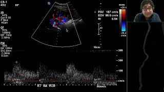 Fibromuscular Dysplasia [upl. by Aynatan328]