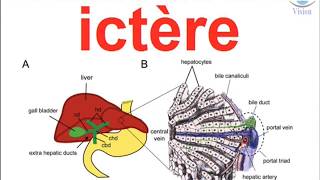 Diagnostique Medical de lictere a bilirubine conjuguée ou non physiopathologie néonatal nouveau né [upl. by Izy]