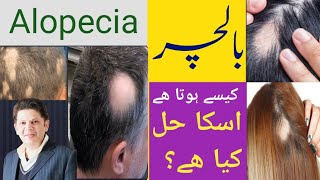 Alopecia Areata  balchar Symptoms  Treatment  Regrowth of Hairs  Hairfall Reasons  Hindi urdu [upl. by Nelg]