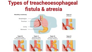 Types of treacheoesophageal fistula amp Atresia ll TEF ll pediatrics ll medical education [upl. by Nnaeerb]