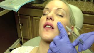 Botox amp Juvederm Lip Injection in Virginia by Dr Naderi DC VA MD [upl. by Anrehs]