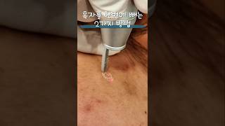 흑자제거 한번에 흑자제거skincare lentigovlog laser [upl. by Vladamir545]