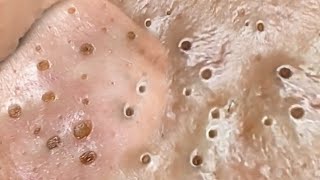 Deep Big Removal Of Blackheads Ear Nose [upl. by Burck493]