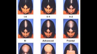 Home Treatment For Alopecia  Alopecia Natural Cures [upl. by Einoj]