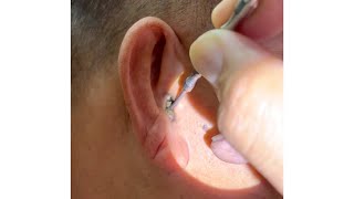 Removing Grandpas 70 Year Old Hard Earwax [upl. by Hawkie]