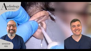 IRRIGATION OF DARK EAR WAX PLUG amp 2 MORE EAR WAX REMOVALS  EP830 [upl. by Arraeit999]